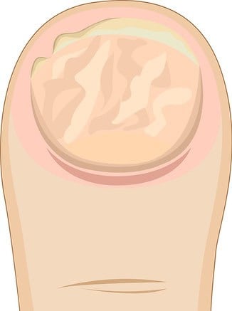 zweite Stufe der Pilzinfektion