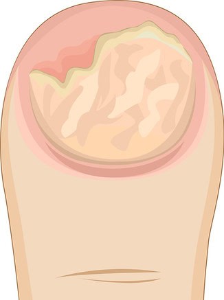 dritte Stufe der Pilzinfektion