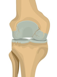Zweites Stadium der Arthrose
