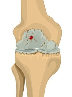 Arthrose im Stadium 3