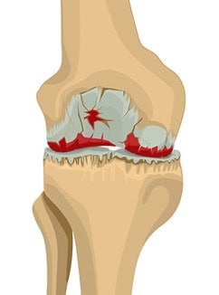 Arthrose im Stadium 4