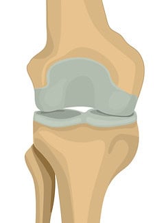 Erstes Stadium der Arthrose