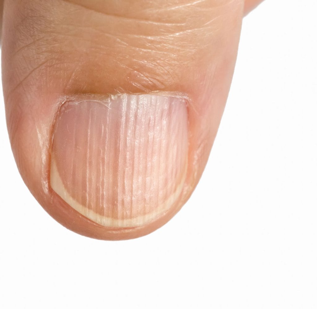 Es ist kein Nagelpilz