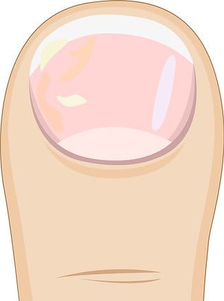 erstes Stadium der Pilzinfektion