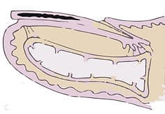 interlaminäre Nagelpilz