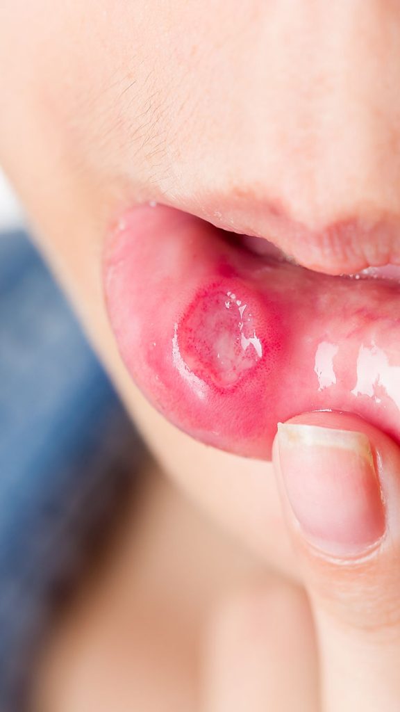 Aphthen im Mund