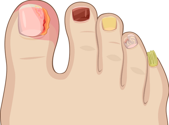 Pilzähnliche Nagelerkrankungen