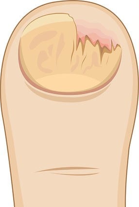 Durch Dermatophyten verursachte Pilze