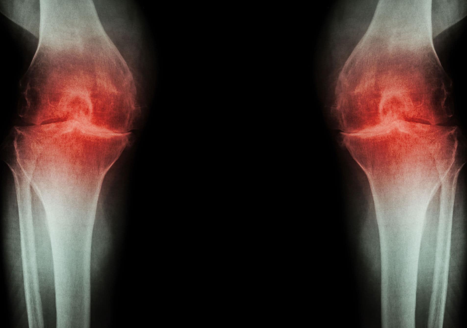 Rentgenska slika astroze v kolenu