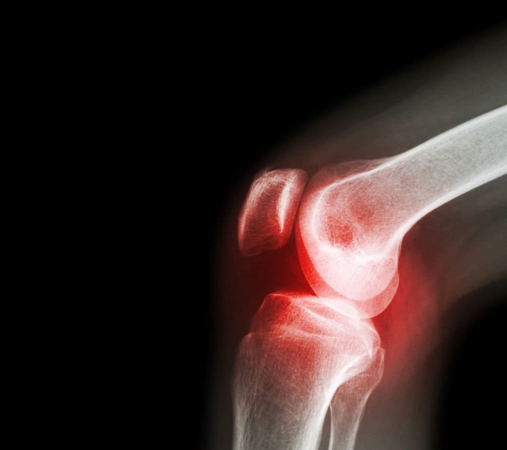 Arthrose und Knieschmerzen werden durch Abnutzung des Knorpels verursacht