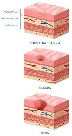 Bolečine v trebuhu zaradi rane na želodcu