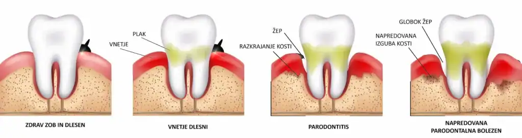 vnetje dlesni - potek