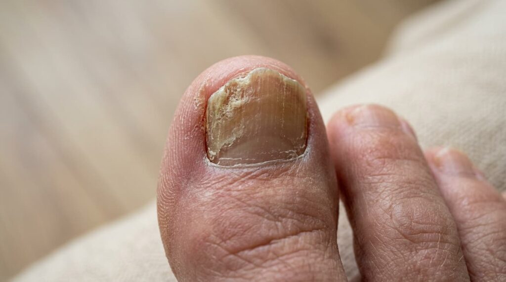 glivice na nohtu noge rumen zadebeljen noht onihomikoza