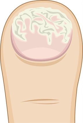 Durch Schimmelpilze verursachte Pilze