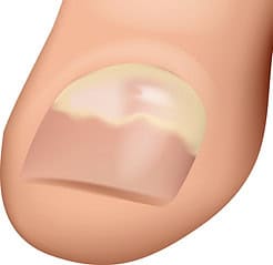 Proximale subunguale Pilze