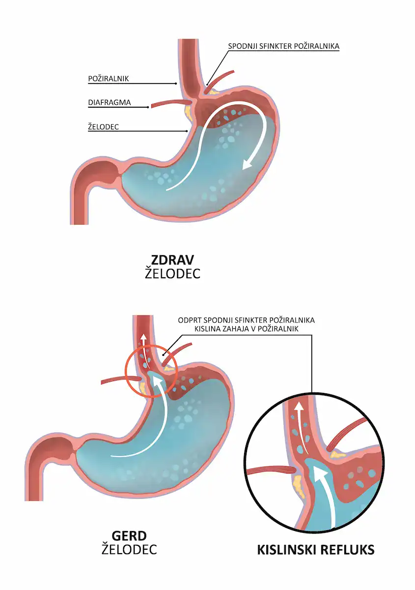 Refluks i bolovi u želucu
