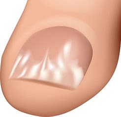 Weiße Oberflächenpilze