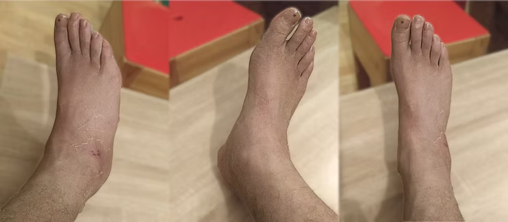 Grade 3 ankle sprain after 1 month