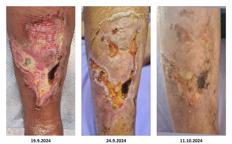 Odprta rana na nogi - primer 5