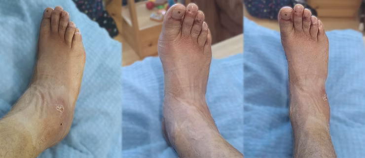 grade 3 ankle sprain after 15 days