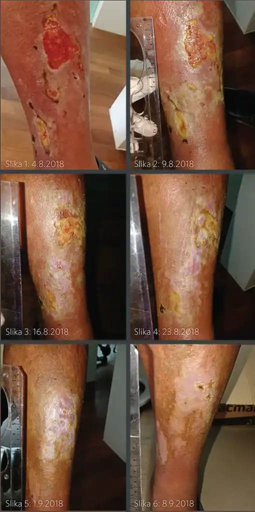 Zaradi zmanjšane prekrvavitve je nastala odprta rana na nogi