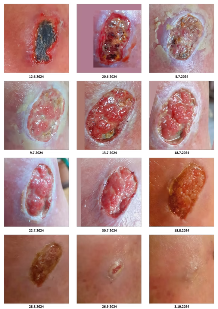 Odprta rana na nogi zaradi ščitnice