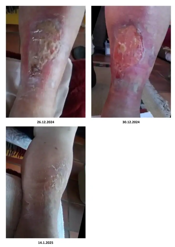 Odprta rana na nogi (golen)