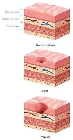 Abdominal pain due to a stomach wound