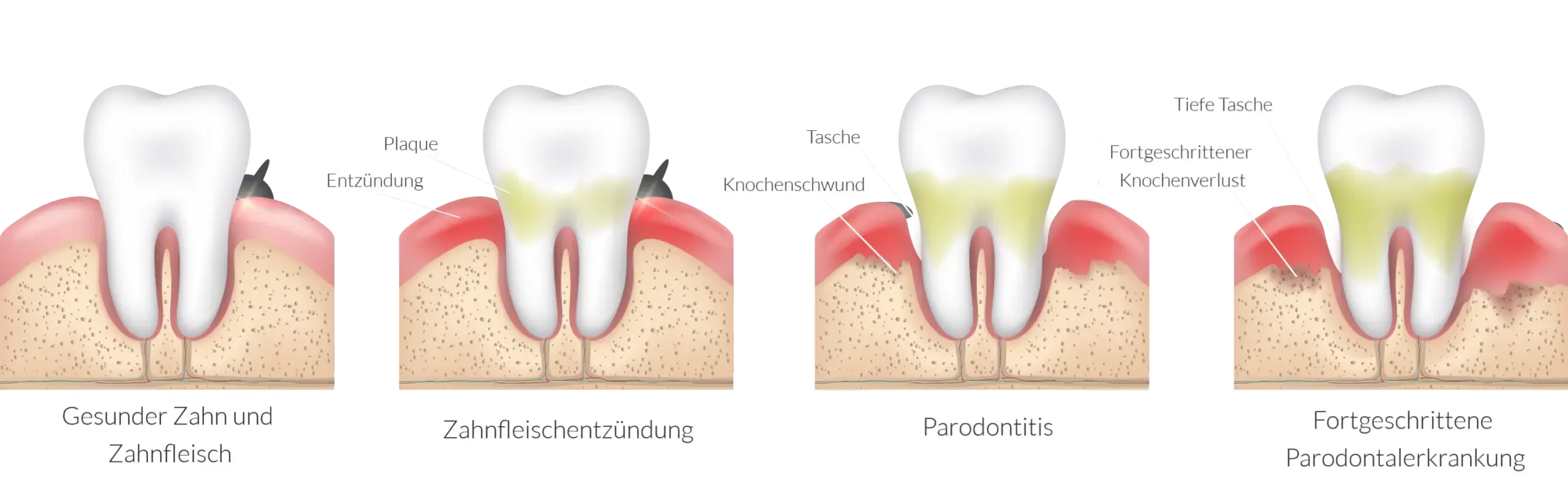 Gingivitis - der Verlauf
