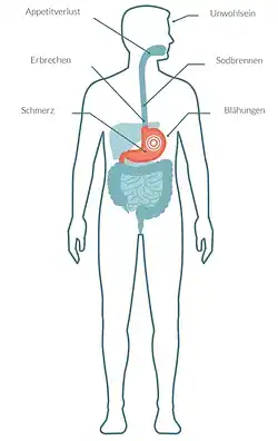 Symptome einer Gastritis