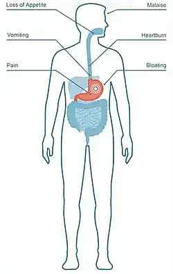 Symptoms of gastritis