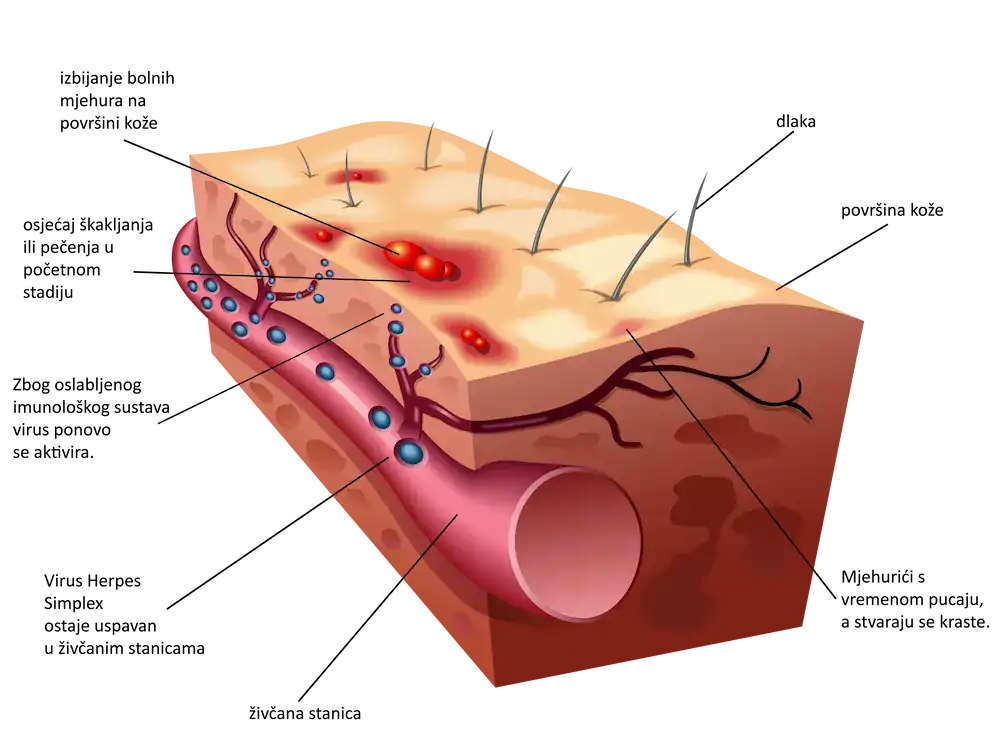 herpes - mehanizam