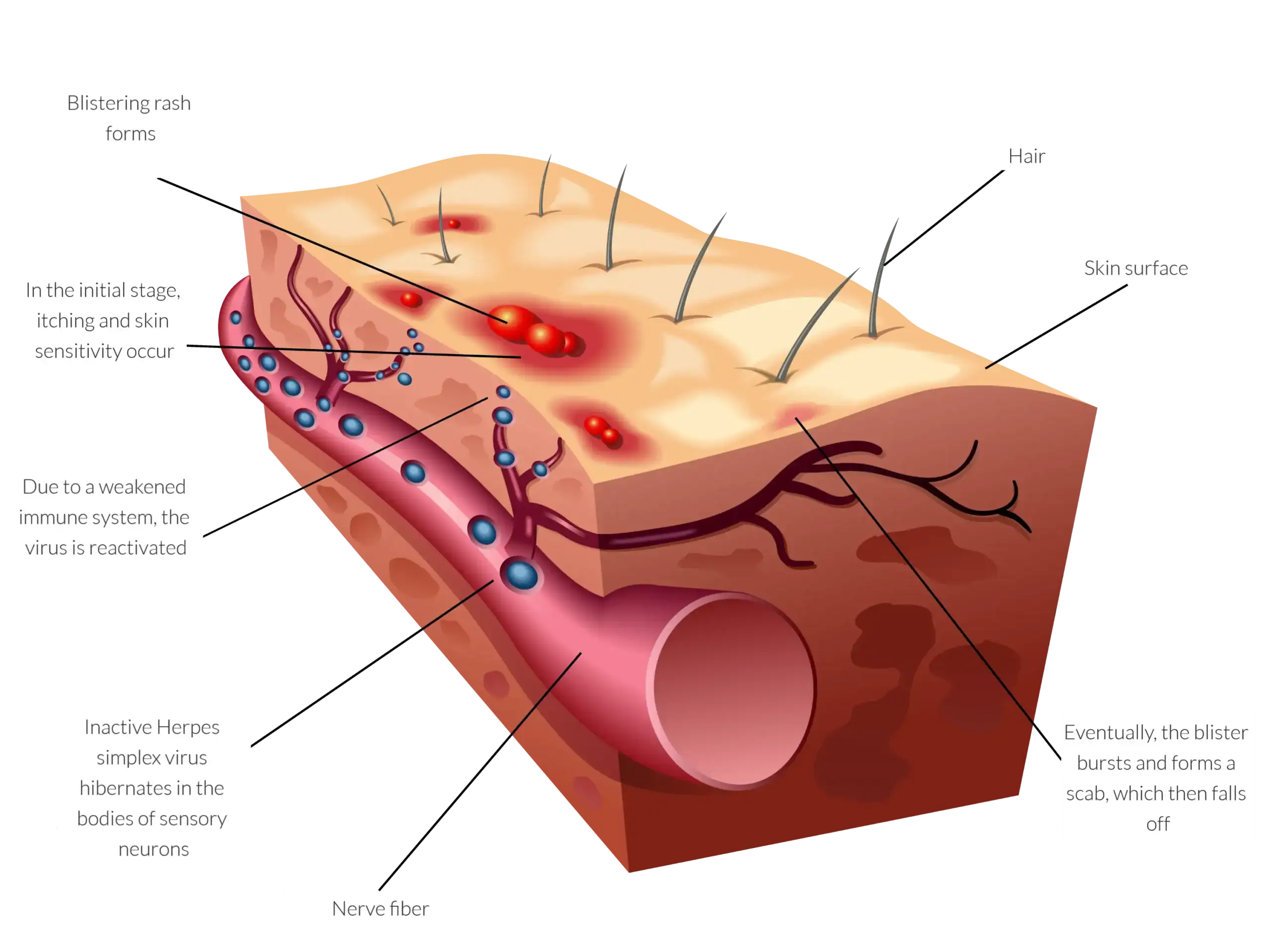 herpes - mechanism of action