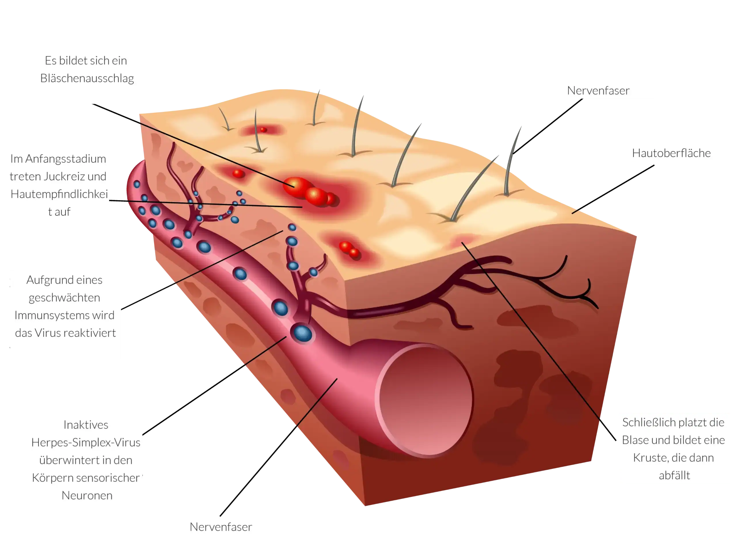 Herpes - Wirkmechanismus