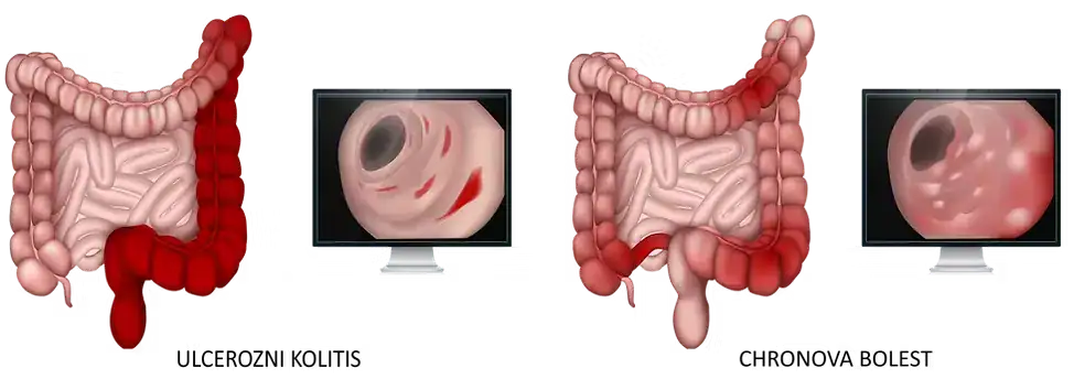 Kronična upalna bolest crijeva