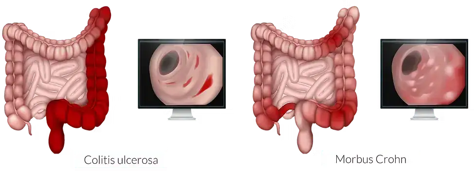 Chronisch entzündliche Darmerkrankungen