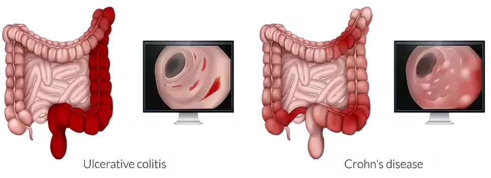 Chronic inflammatory bowel disease
