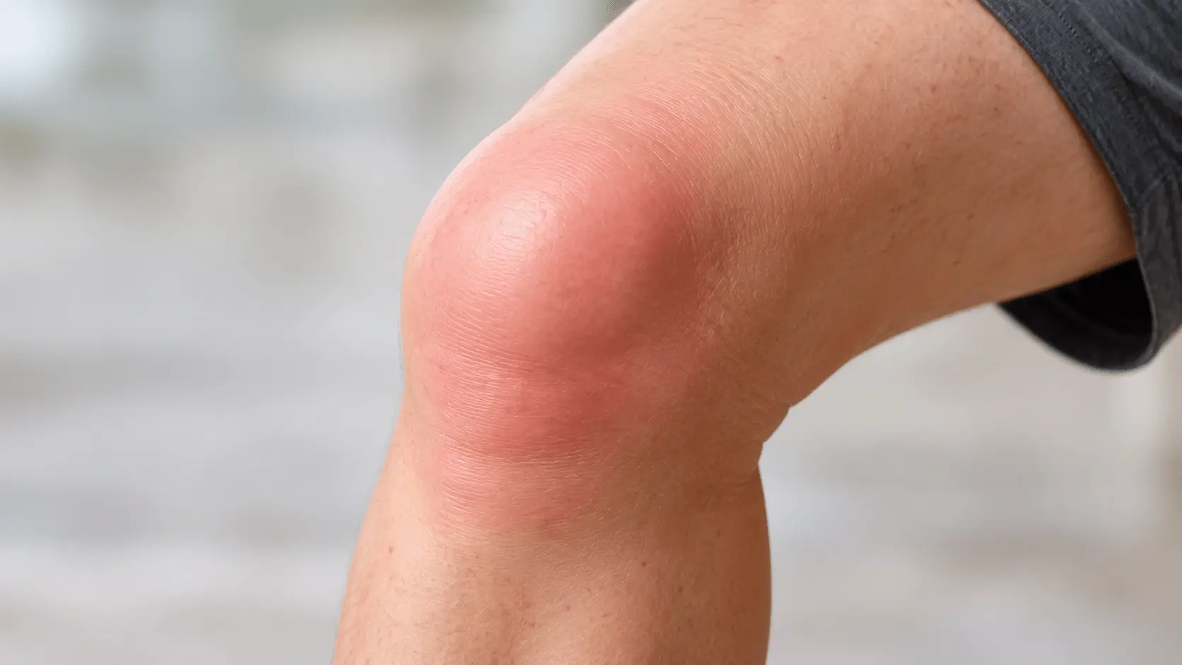 Geschwollenes und gerötetes Knie
