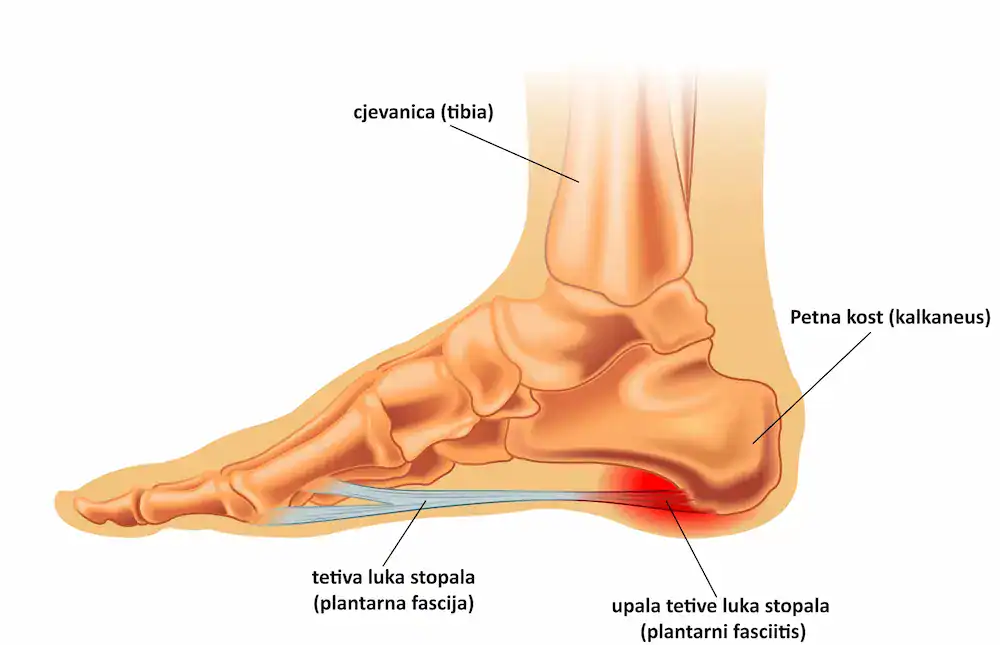 Upala tetive svodnog luka stopala