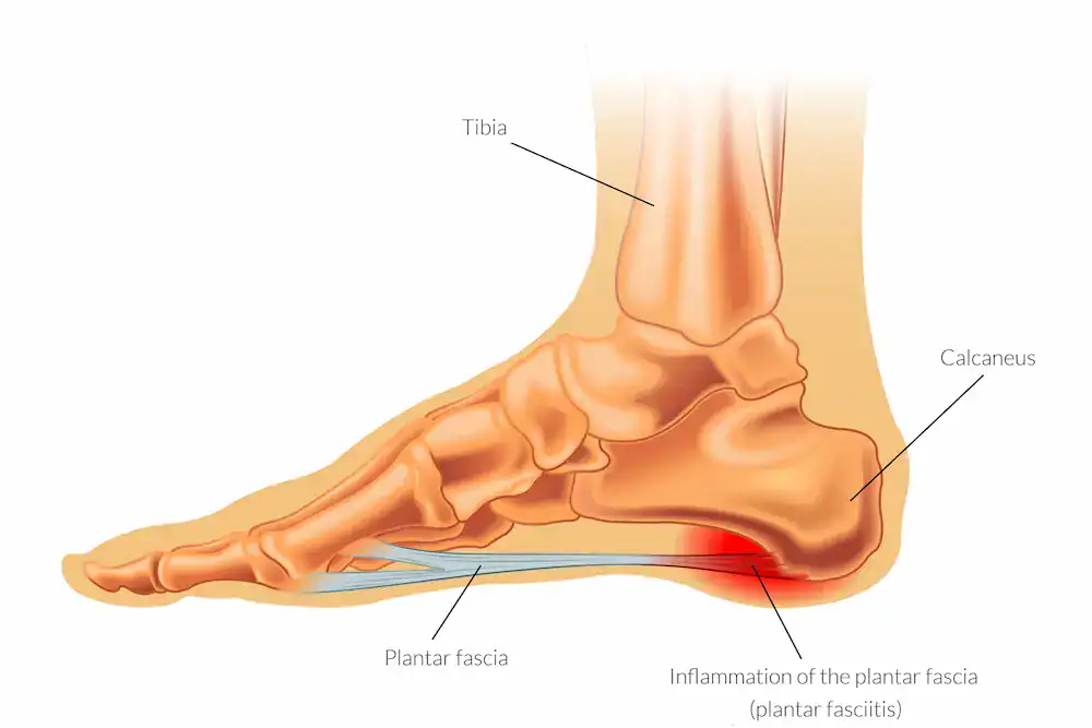 Inflammation of the tendon of the arch of the foot