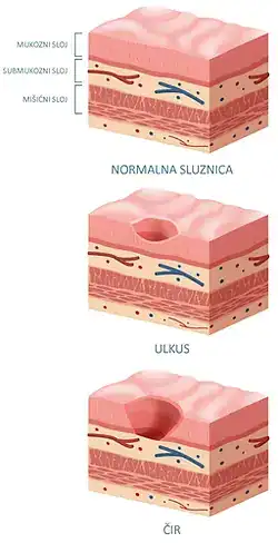 Bolovi u trbuhu zbog ulkusa na želucu