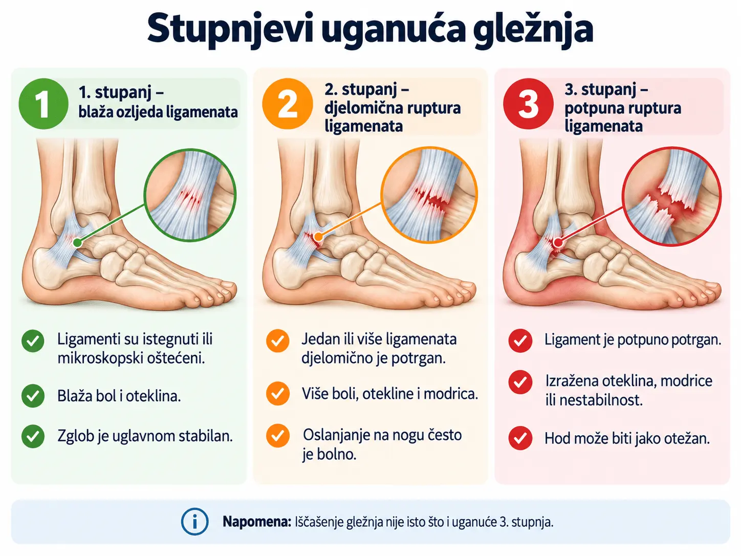 Stupnjevi uganuća gležnja: blaža ozljeda ligamenata, djelomično puknuće i potpuno puknuće ligamenata.