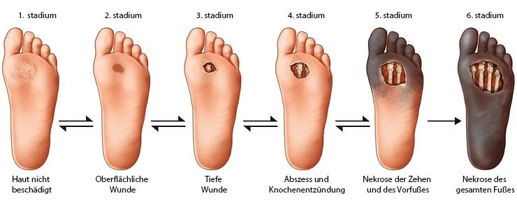 Der Verlauf der Entwicklung einer offenen Wunde am Bein bei Diabetes