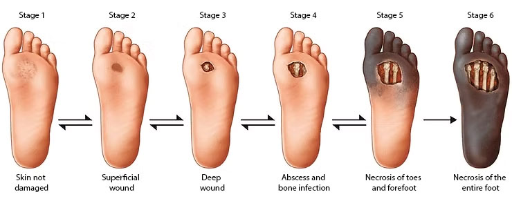 The course of how an open wound on the leg develops in diabetes