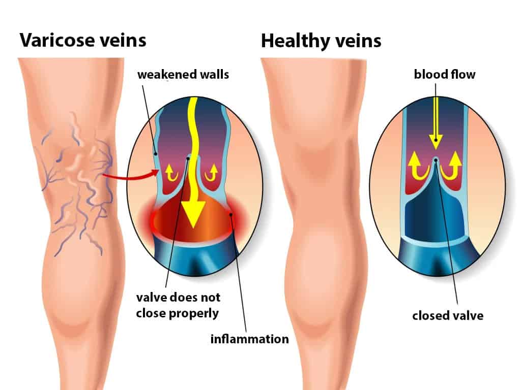 Venous insufficiency - can result in a leg wound