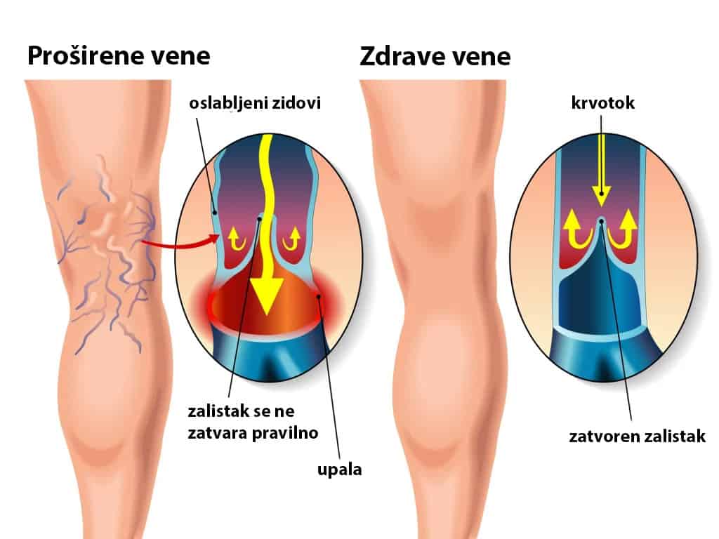 Vensko popuštanje – posljedica može biti rana na nozi