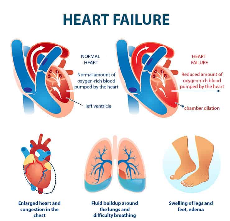 An open wound on the leg can occur as a result of heart failure