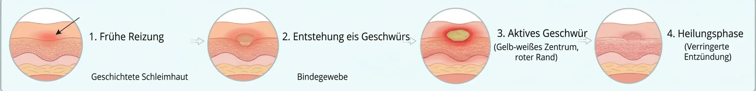 Phasen der Entwicklung von Aphthen im Mund