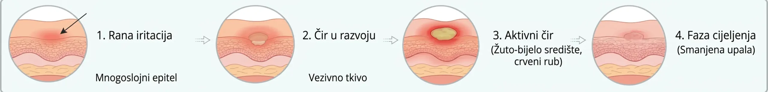 Faze razvoja afte u ustima