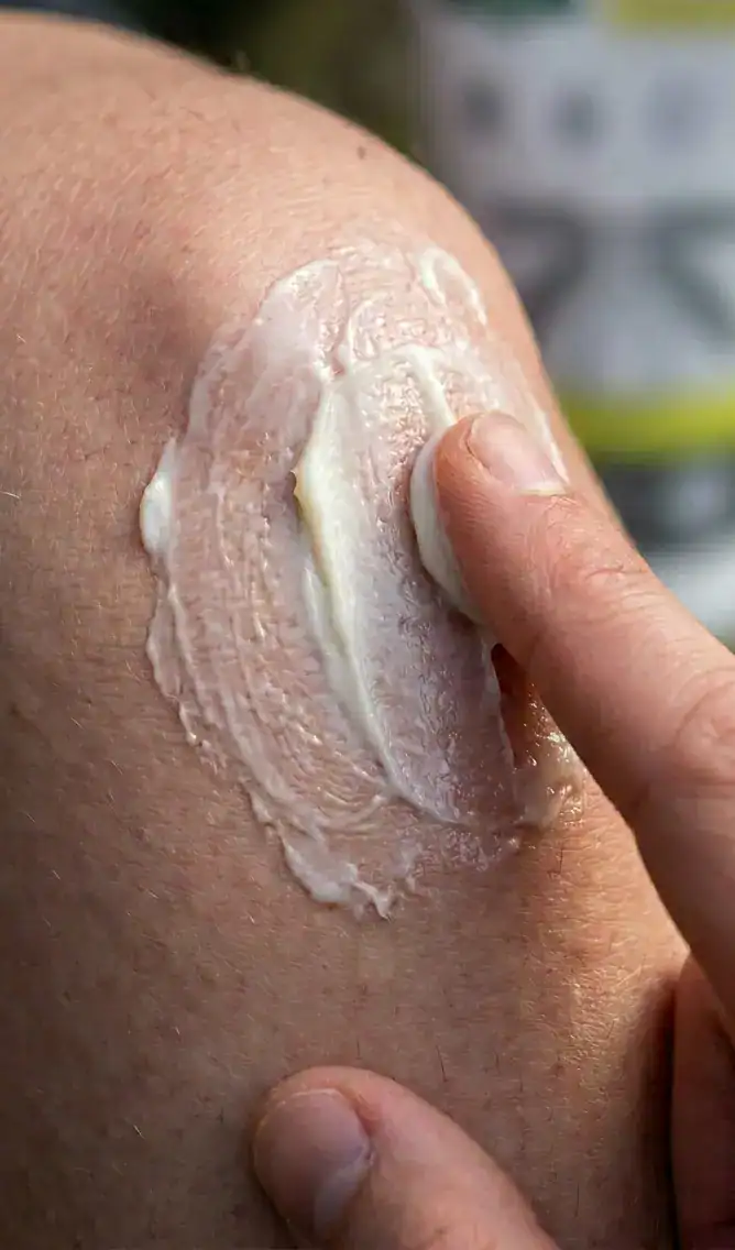 Lokalno nanašanje kreme pri bolečinah v kolenu